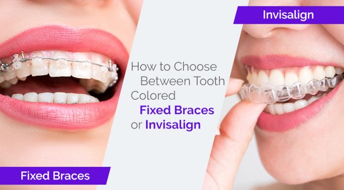 How to Choose Between Tooth Colored Fixed Braces or Invisalign How to Choose Between Tooth Colored Fixed Braces or Invisalign
